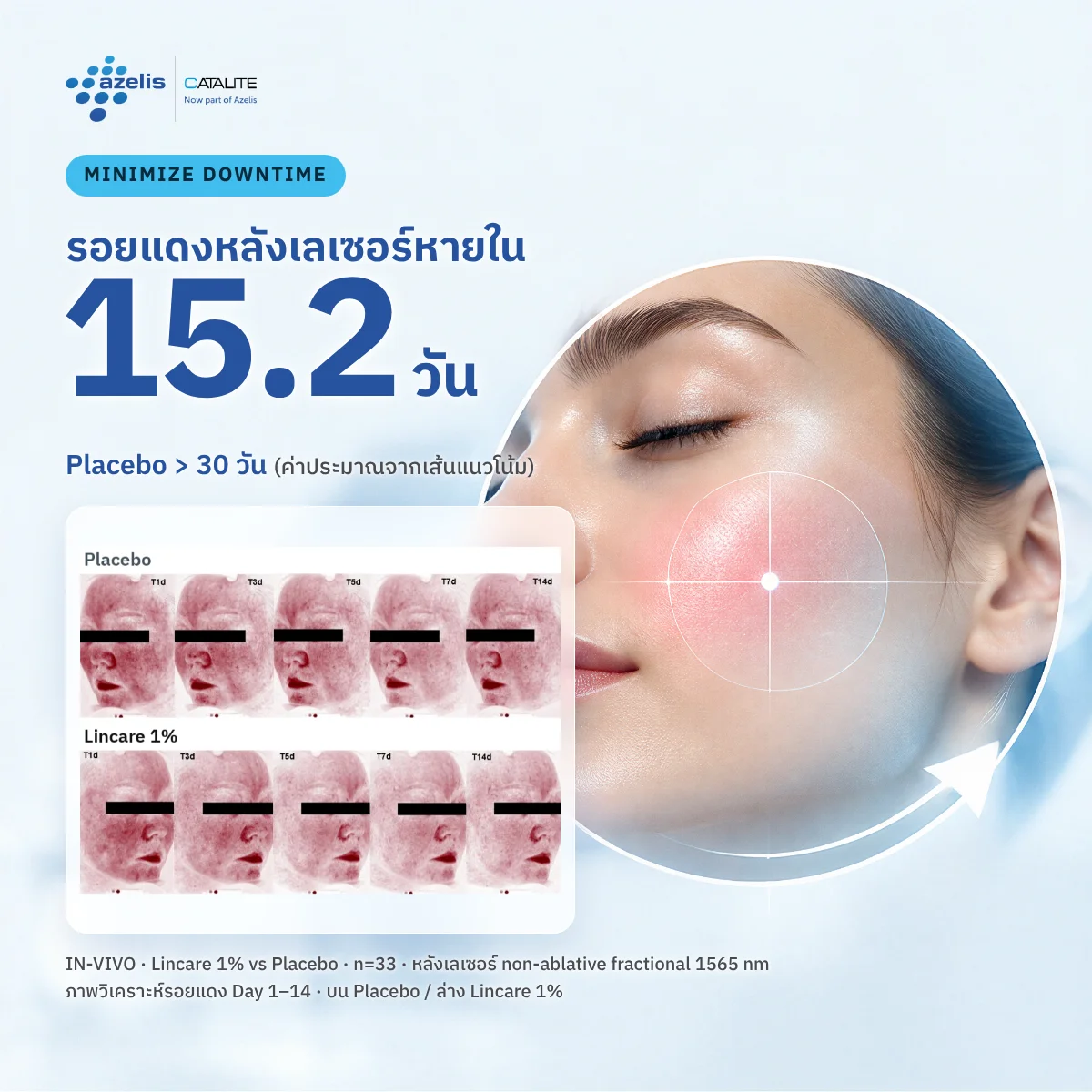 ผลทดสอบ in-vivo: รอยแดงหลังเลเซอร์กลับสู่ baseline เร็วกว่า Placebo